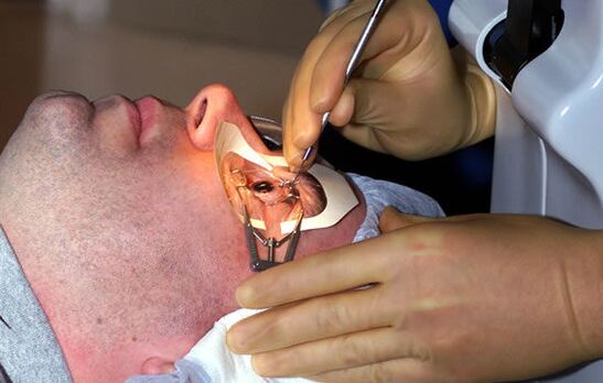 Σκληροπλαστική για μυωπία για σταθεροποίηση της όρασης