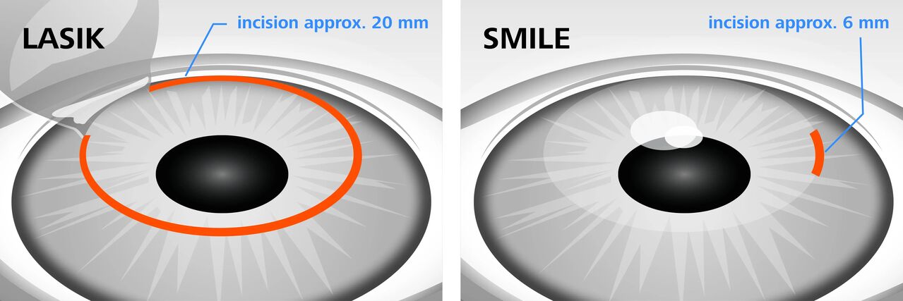 Σύγκριση μεθόδων διόρθωσης όρασης με laser LASIK και SMILE